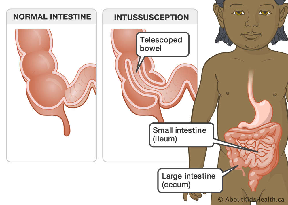 Location of small and large intestines in a child and close-ups on a normal intestine and an intestine with intussusception