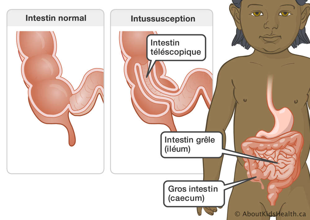 L’intestin grêle et le gros intestin dans un enfant et des gros plans sur un intestin normal et un intestin téléscopique