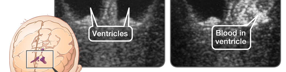 Normal head ultrasound and IVH grade II ultrasound with bleeding in ventricles