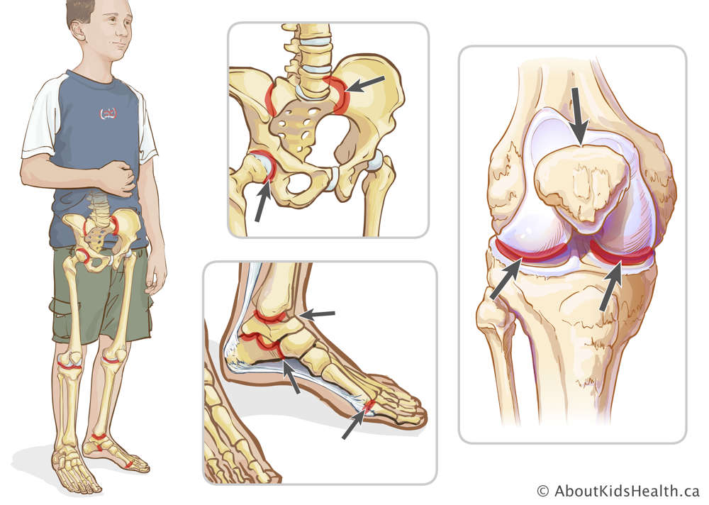 Lower joints that may be affected by ERA