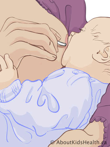 Sliding tube beside nipple and into baby&rsquo;s mouth while baby is latched on