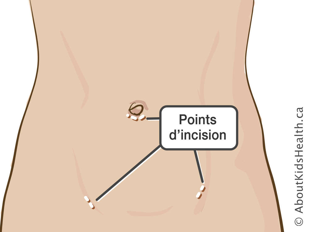 Points d’incision sous le nombril et sur le bas de l’abdomen