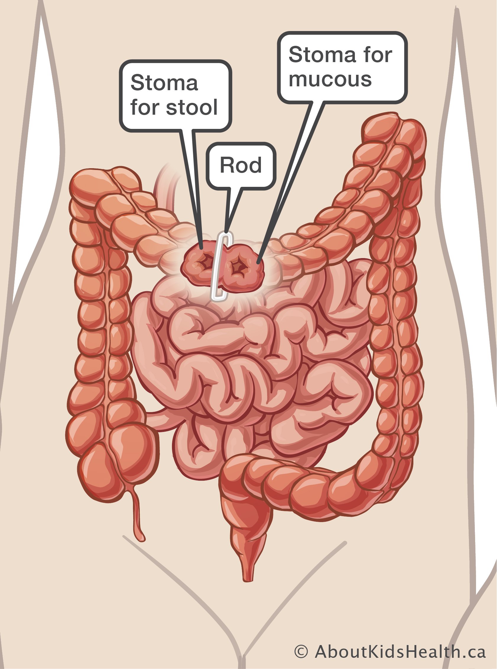 Medical illustration of loop ostomy which has a loop of bowel outside of abdomen and a rod wrapped around the middle