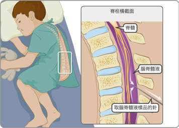 近距離示意圖:位於頭骨和大腦之間的正常腦膜,以及發炎的腦膜
