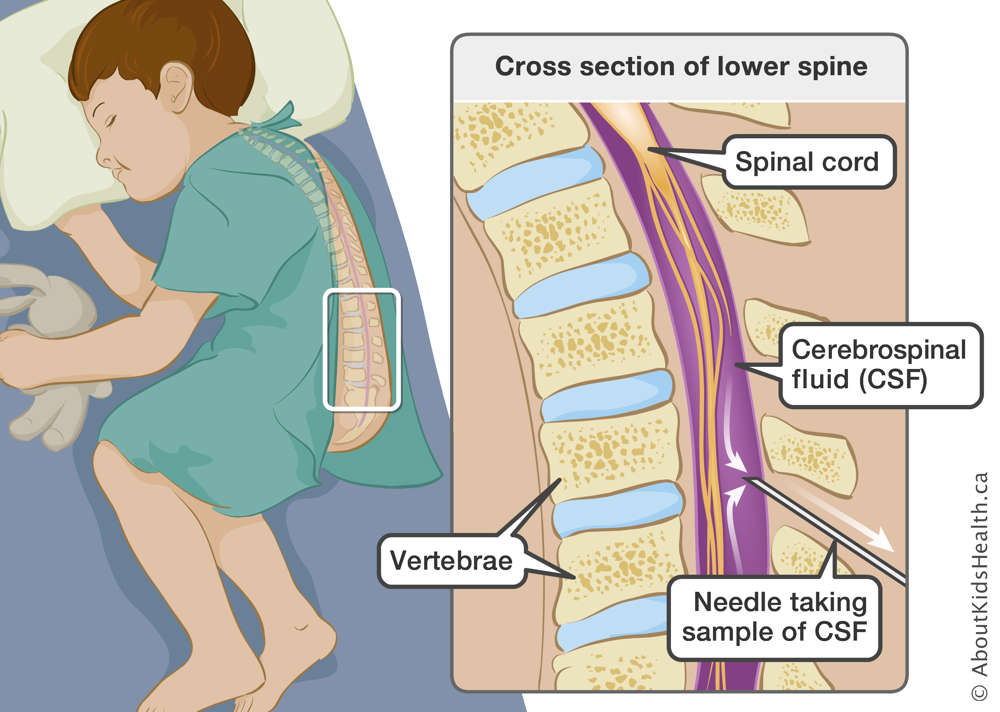 Cross section of lower spine with needle inserted between vertebrae to take a sample of cerebrospinal fluid