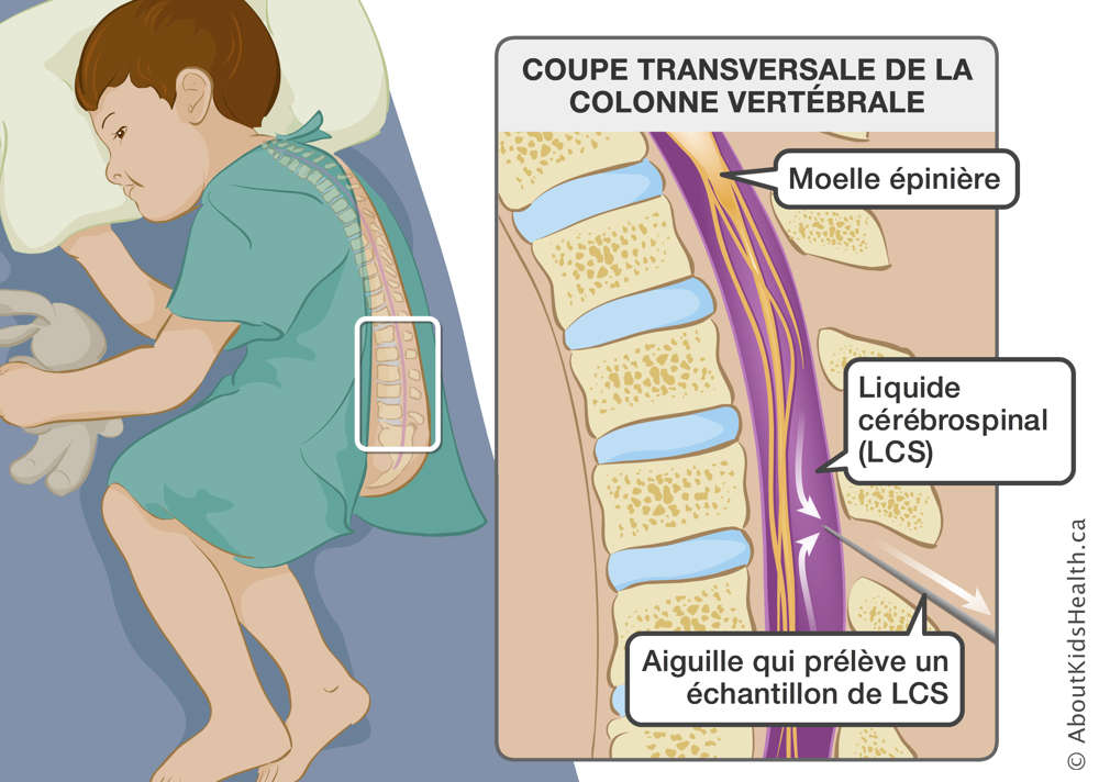 L’identification de la moelle épinière, du liquide cérébrospinal (LCS) et d’une aiguille qui prélève un échantillon de LCS
