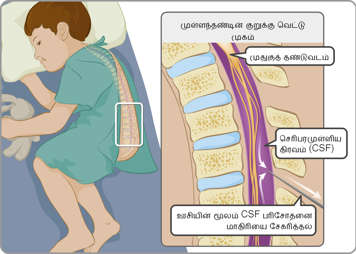 மூளை முண்ணான் பாயத்தின் (CSF) மாதிரி எடுப்பதற்காக செலுத்தப்பட்ட ஊசியுடன் முள்ளந்தண்டு, முண்ணான் மற்றும் மூளை முண்ணான் பாயம்