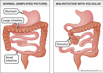 Normal stomach and small and large intestines beside a gi tract with large intestine wrapped around part of small intestine