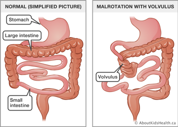 Normal stomach and small and large intestines beside a gi tract with large intestine wrapped around part of small intestine