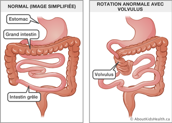 Image simplifi&eacute;e d&rsquo;un estomac, grand instestin et intestin gr&ecirc;le normaux, et illustration de rotation anormale avec volvulus