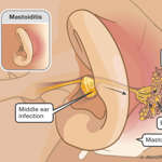 Medical illustration with middle ear infection and bacteria in the mastoid air cells within the mastoid bone behind the ear