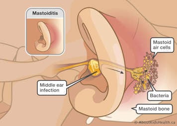 Medical illustration with middle ear infection and bacteria in the mastoid air cells within the mastoid bone behind the ear