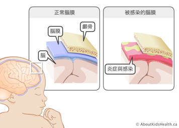 近距離示意圖:位於頭骨和大腦之間的正常腦膜,以及發炎的腦膜
