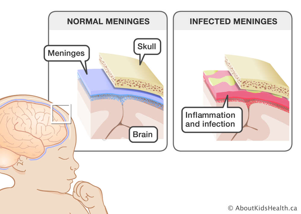 Close-ups of normal meninges between the skull and brain, and infected meninges with inflammation