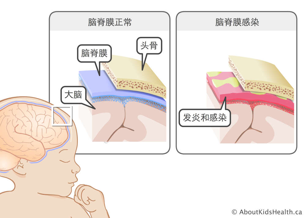 近距离示意图：位于头骨和大脑之间的正常脑膜，以及发炎的脑膜