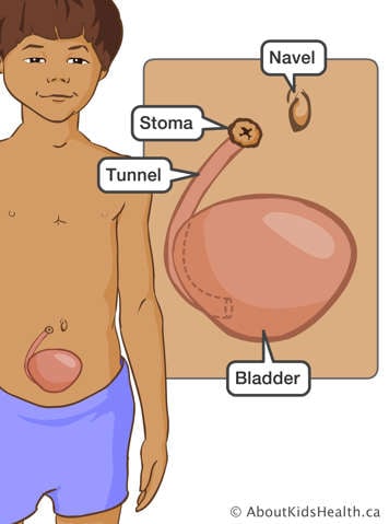 Identification of navel, bladder, tunnel and stoma in a child