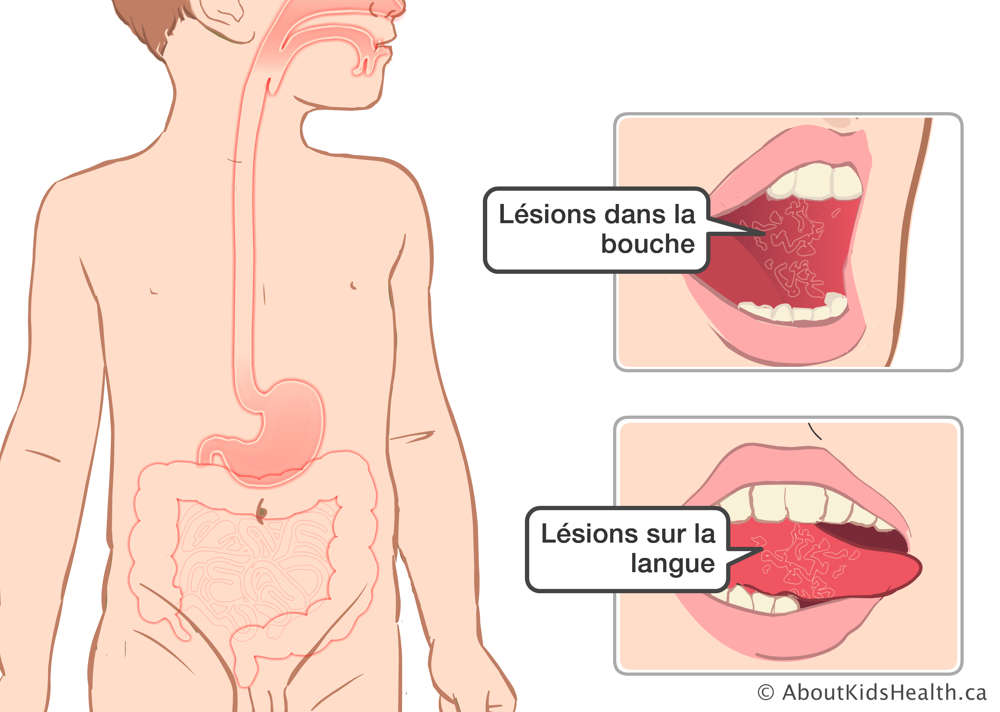 Des l&eacute;sions dans la bouche et sur la c&ocirc;t&eacute; de la langue