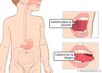 Des lésions dans la bouche et sur la côté de la langue