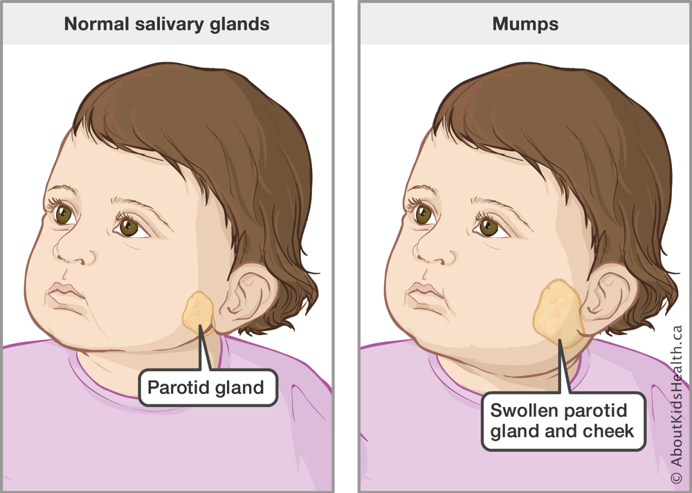 Toddler with normal parotid gland, located along the jaw near base of ear, and toddler with swollen parotid gland and cheek
