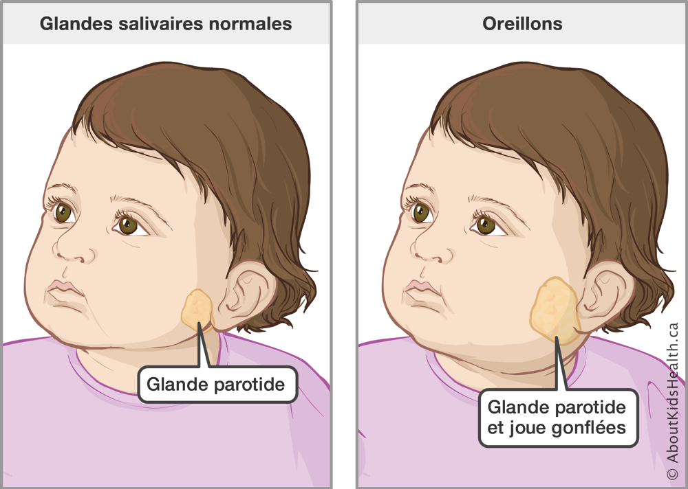 Un tout-petit avec la glande parotide ou salivaire normale et un tout-petit avec la glande parotide et la joue gonflée