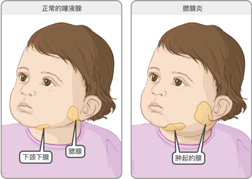 腮腺位于两侧耳根处,靠近下颌线。图中分别为腮腺正常的幼童,以及腮腺及面颊肿胀的幼童