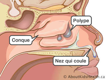 Illustration de la conque et des polypes à l’intérieur d’un nez qui coule