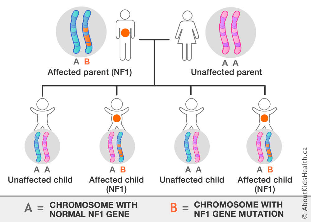Chromosome distribution from an affected parent with one chromosome with NF1 gene mutation an unaffected parent