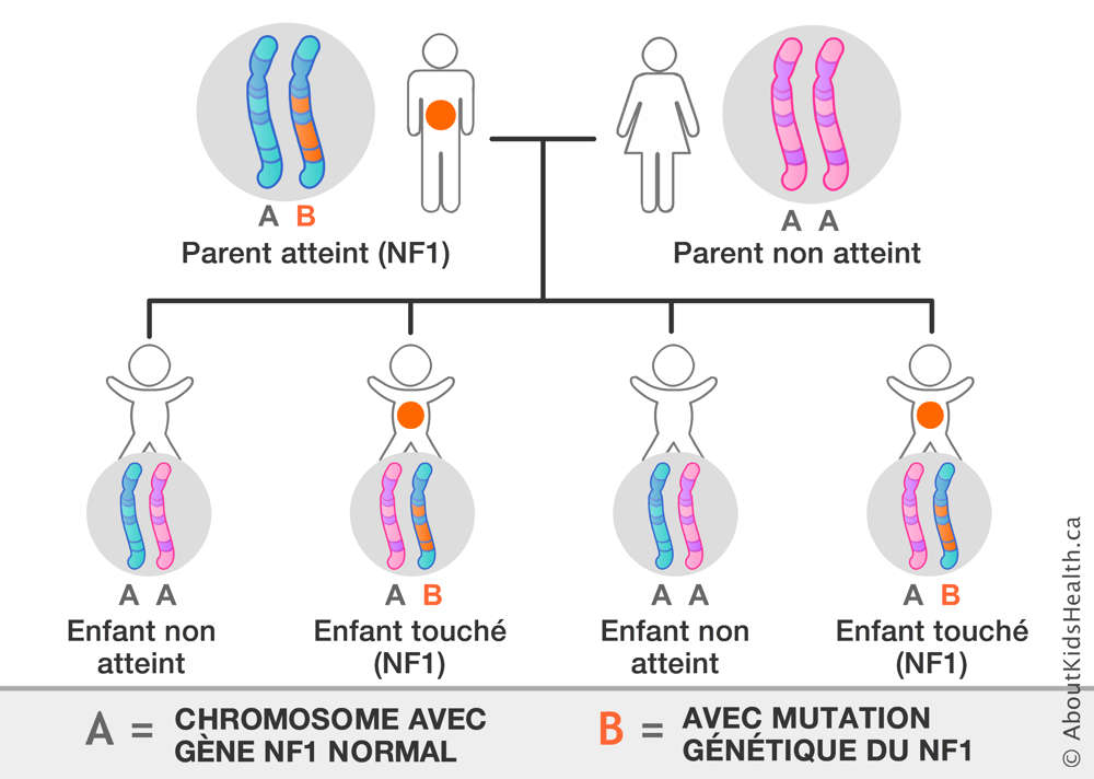 Distribution des chromosomes d’un parent portant un chromosome avec mutation génétique du NF1 et d'un parent non atteint