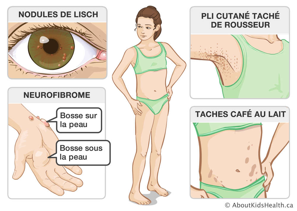 Nodules de Lisch, bosses sur et sous la peau, pli cutané taché de rousseur et taches café au lait sur le corps d’une fille