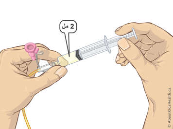 Two millilitres of liquid in a syringe attached to an NG tube