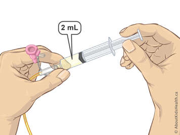 Two millilitres of liquid in a syringe attached to an NG tube