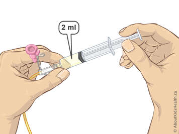 Deux millilitres de liquide dans une seringue attach&eacute;e &agrave; une sonde nasogastrique