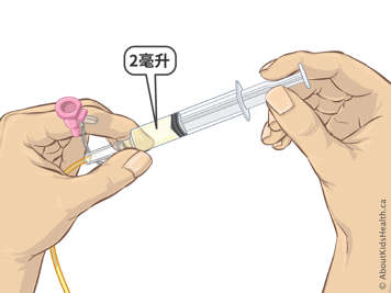 Medical illustration of a person holding a syringe containing about 2 mL of stomach contents.