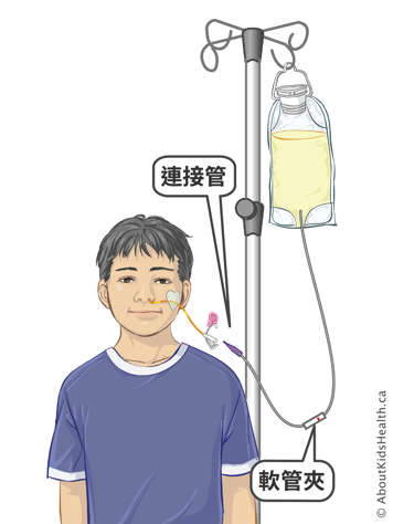 Medical illustration of a child receiving feeding through a nasogastric (NG) tube using gravity.