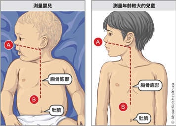 嬰兒及稍年長兒童的鼻胃管測量示意圖,以及二者胸骨底部和肚臍位置3: 在帶有兩個端口和可拆卸導線的鼻胃管上做標記