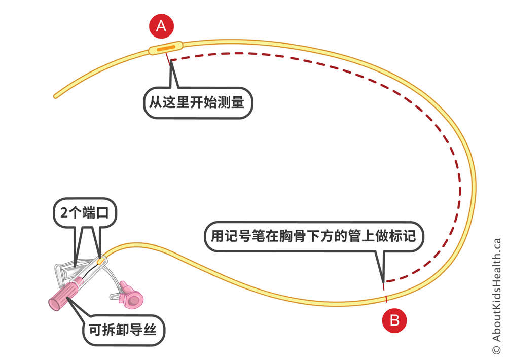 在帶有兩個端口和可拆卸導線的鼻胃管上做標記