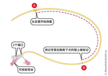 在帶有兩個端口和可拆卸導線的鼻胃管上做標記