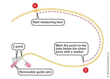 Markings on a NG tube with two ports and removable guarded wire at starting point and point on the tube below the chest bone