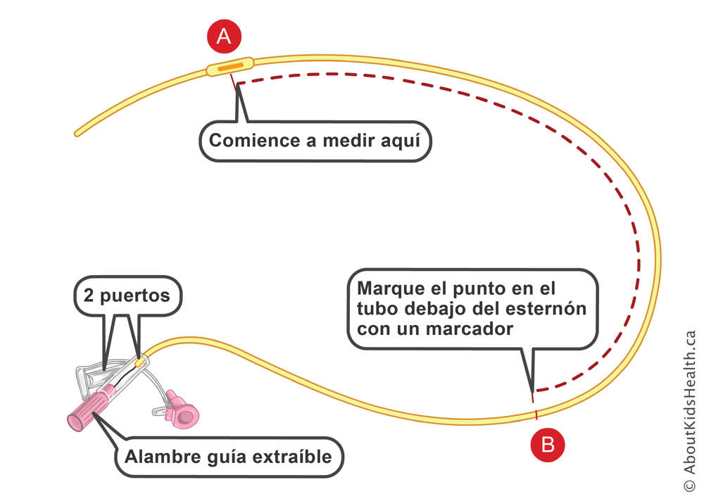 Marcas en una sonda nasog&aacute;strica con dos puertos y cable gu&iacute;a desmontable