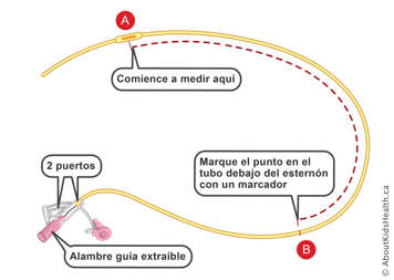 Marcas en una sonda nasog&aacute;strica con dos puertos y cable gu&iacute;a desmontable