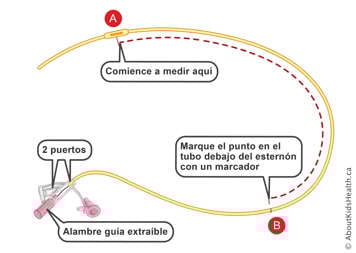 Marcas en una sonda nasogástrica con dos puertos y cable guía desmontable
