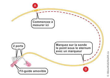 Marques du point de commencement et du point juste en dessous du sternum sur une sonde nasogastrique