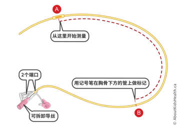 鼻胃管有两个端口，带有可拆卸的保护性导线，分别位于起始点和胸骨下方导管的起始点