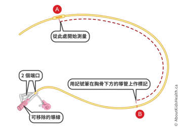 Markings on a NG tube with two ports and removable guarded wire at starting point and point on the tube below the chest bone