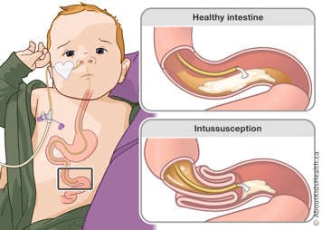 Normal placement of an NJ tube in the jejunum and jejunum with intussusception