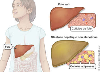 Emplacement du foie avec un parallèle entre un foie et des cellules du foie sains et un foie et des cellules endommagés par l’accumulation de graisses