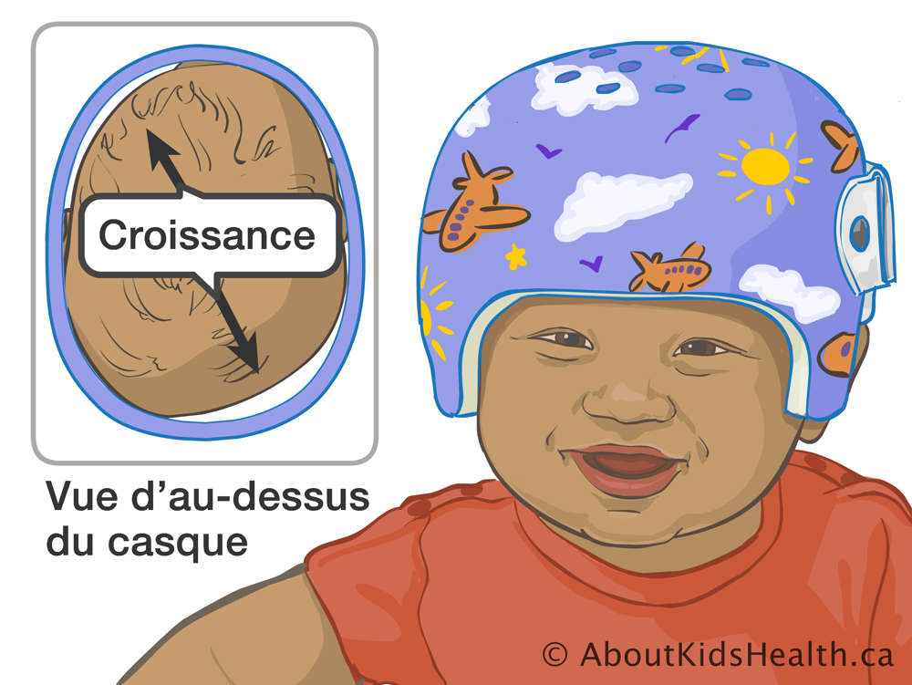 Bébé portant un casque orthopédique et une vue d’au-dessus de la tête dans le casque