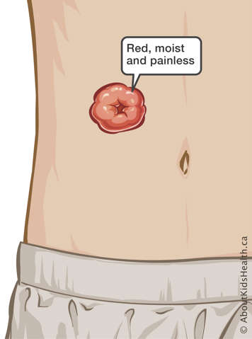 Medical illustration of healthy stoma on abdomen, above and to right of the belly button. Stoma is red, moist and painless