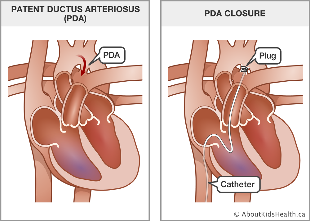 A heart with patent ductus arteriosus and a heart with a catheter and plug inserted to close the PDA