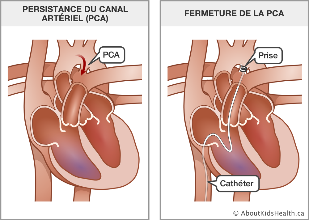 Un cœur avec persistance du canal artériel et un cœur avec un cathéter et une prise insérés pour fermer la PCA